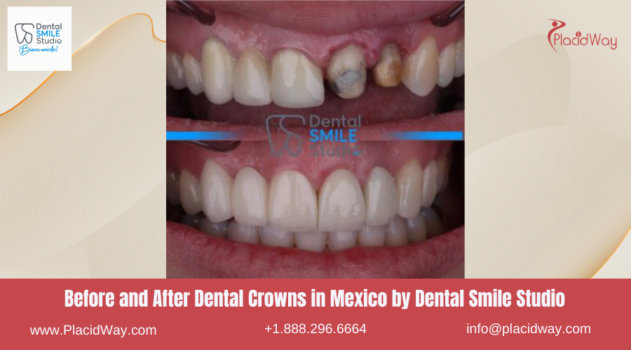 Dental Crowns in Mexico Before and After Image by Dental Smile Studio