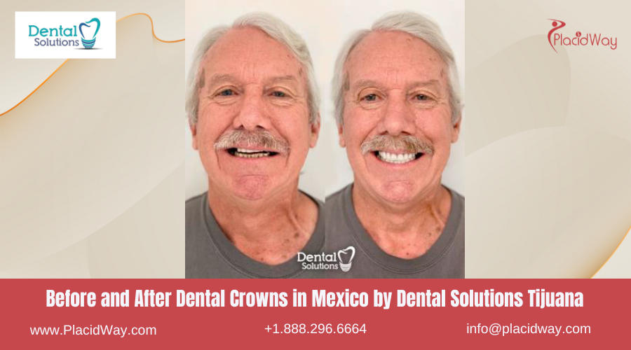 Dental Crowns in Mexico Before and After Image by Dental Solutions