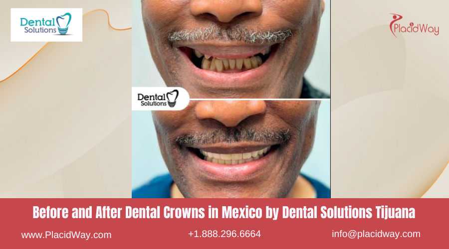 Dental Crowns in Mexico Before and After Image by Dental Solutions Clinic