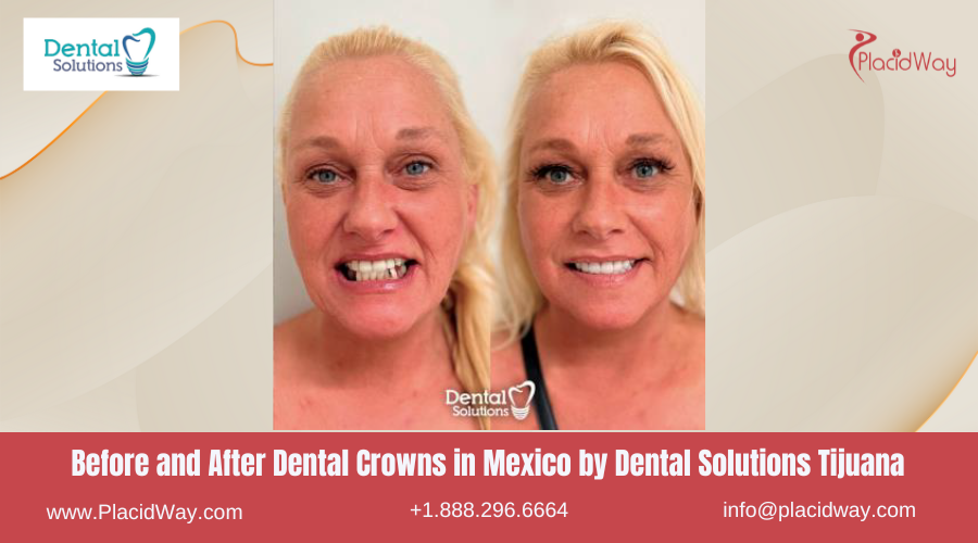 Dental Crowns in Mexico Before and After Image by Dental Solutions Center