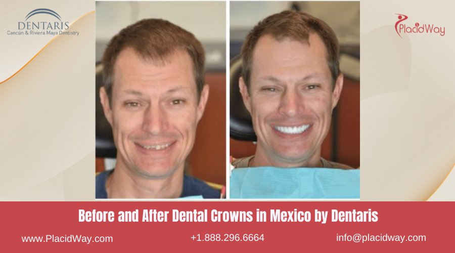 Dental Crowns in Mexico Before and After Image by Dentaris