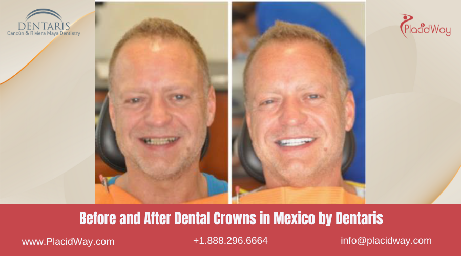Dental Crowns in Mexico Before and After Image by Dentaris Clinic