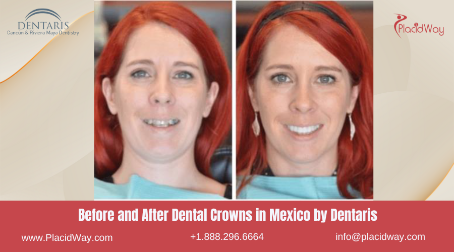 Dental Crowns in Mexico Before and After Image by Dentaris Clinic