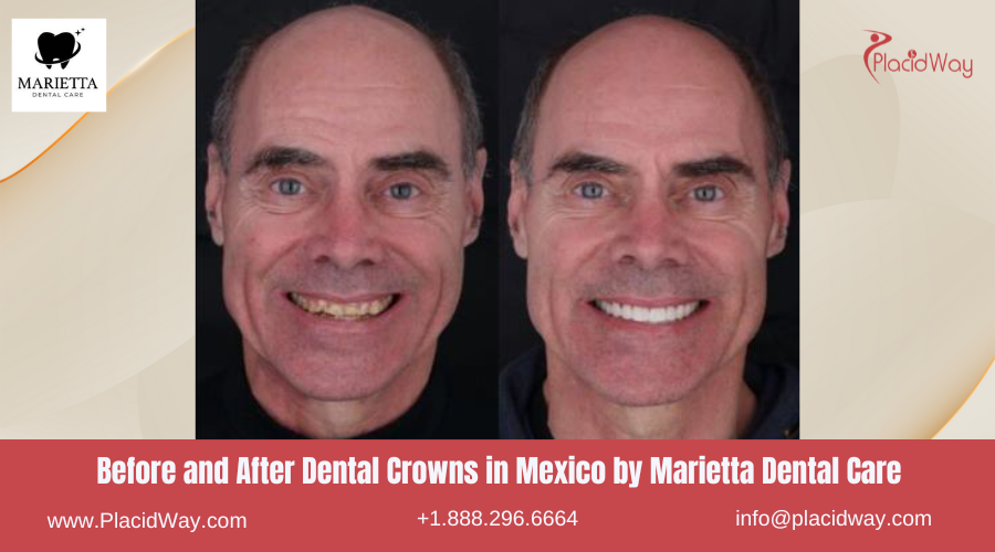 Dental Crowns in Mexico Before and After Image by Marietta