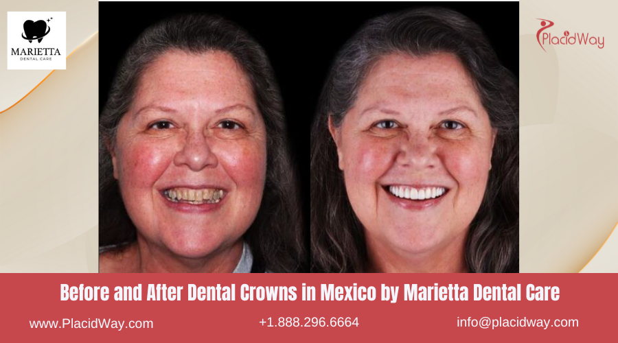 Dental Crowns in Mexico Before and After Image by Marietta Dental Care