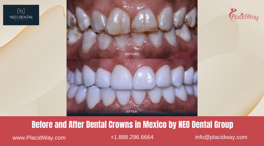 Dental Crowns in Mexico Before and After Image by NEO Dental Group