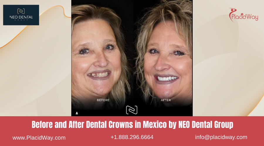 Dental Crowns in Mexico Before and After Image by NEO Dental