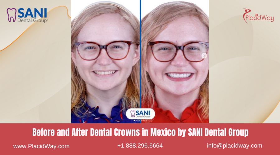 Dental Crowns in Mexico Before and After Image by SANI Dental Group