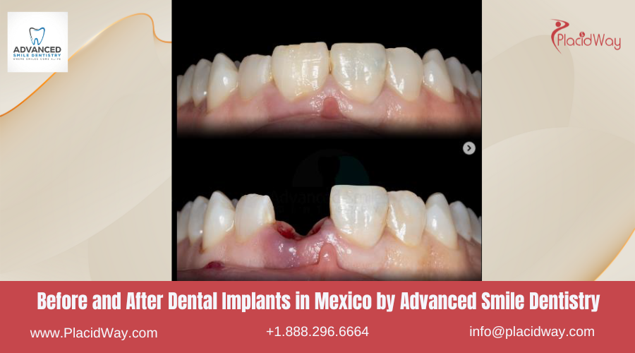 Dental Implants in Mexico Before and After Image by Advanced Smile Dentistry