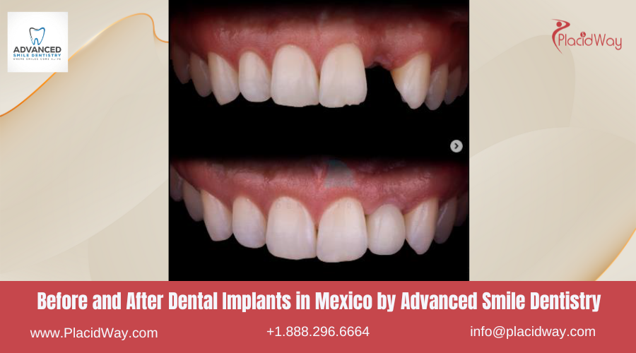 Dental Implants in Mexico Before and After Image by Advanced Smile