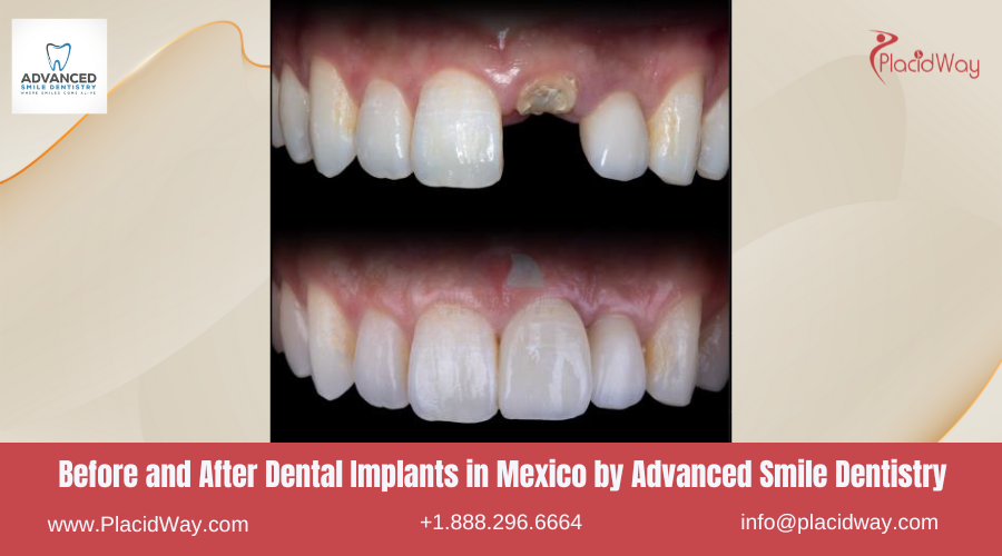 Dental Implants in Mexico Before and After Image by ASD