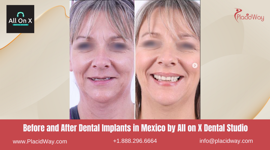 Dental Implants in Mexico Before and After Image by All on X Dental Studio