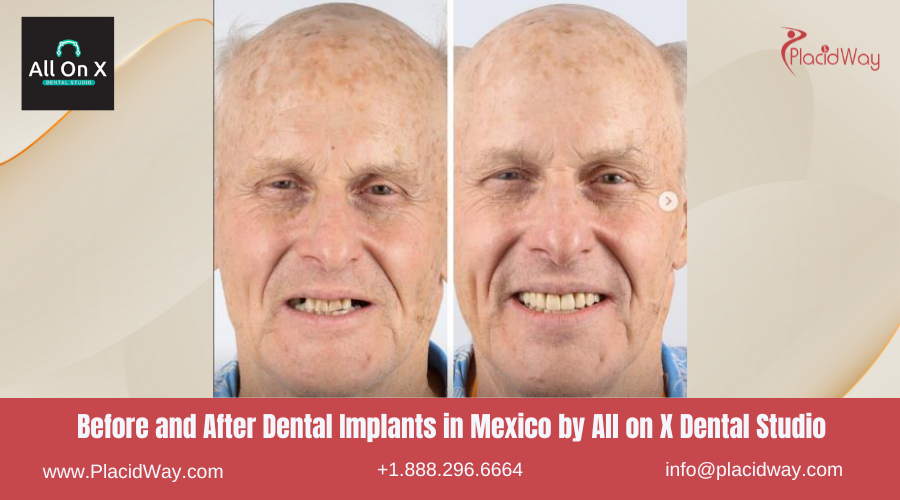 Dental Implants in Mexico Before and After Image by All on X Dental Clinic