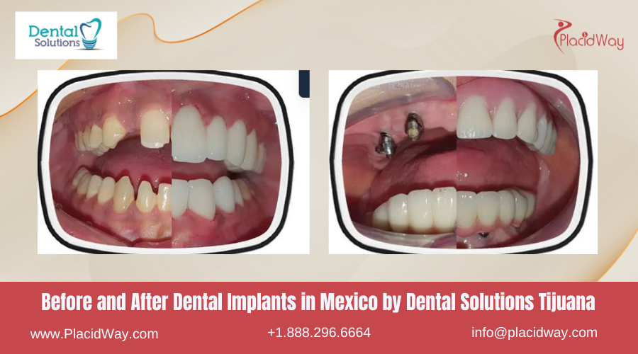 Dental Implants in Mexico Before and After Image by Dental Solutions