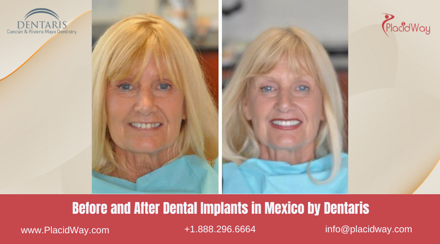 Dental Implants in Mexico Before and After Image by Dentaris
