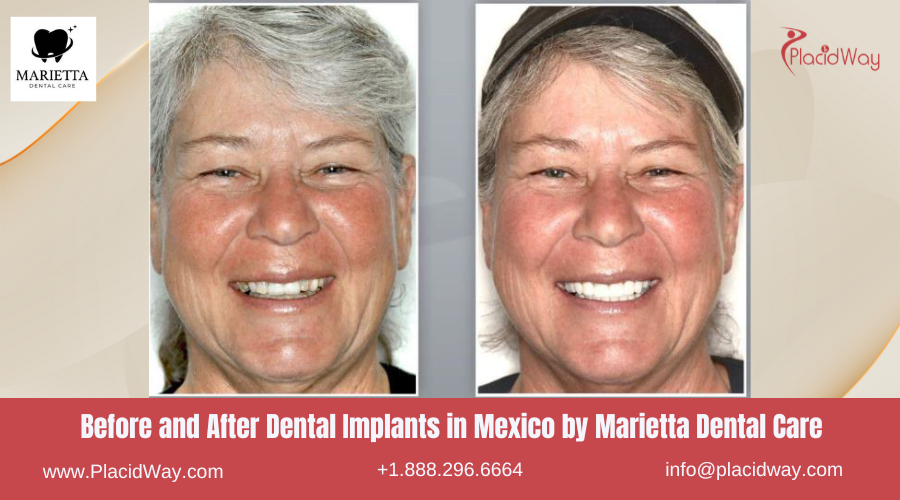 Dental Implants in Mexico Before and After Image by Marietta Dental Care