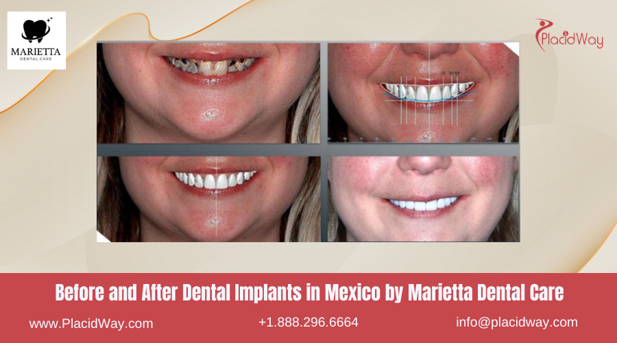 Dental Implants in Mexico Before and After Image by Marietta