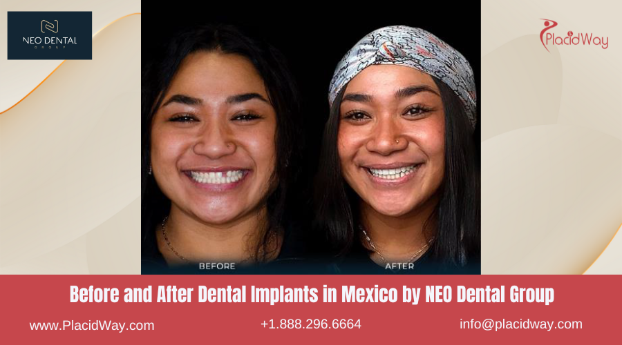 Dental Implants in Mexico Before and After Image by NEO Dental Group