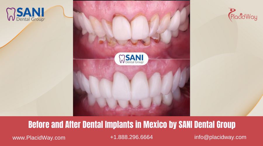 Dental Implants in Mexico Before and After Image by SANI Dental