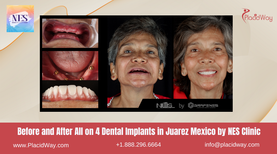 Before and After All on 4 Dental Implants in Juarez Mexico by NES Clinic