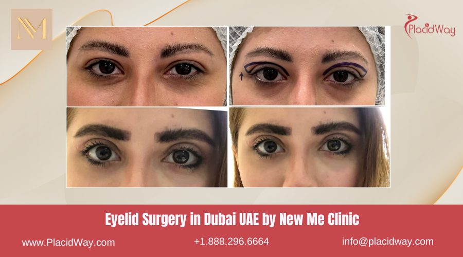 Eyelid Surgery in Dubai UAE by New Me Clinic - Before and After