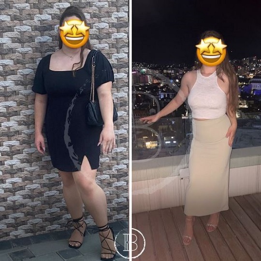 Before After Gastric Balloon Surgery in Istanbul Turkey