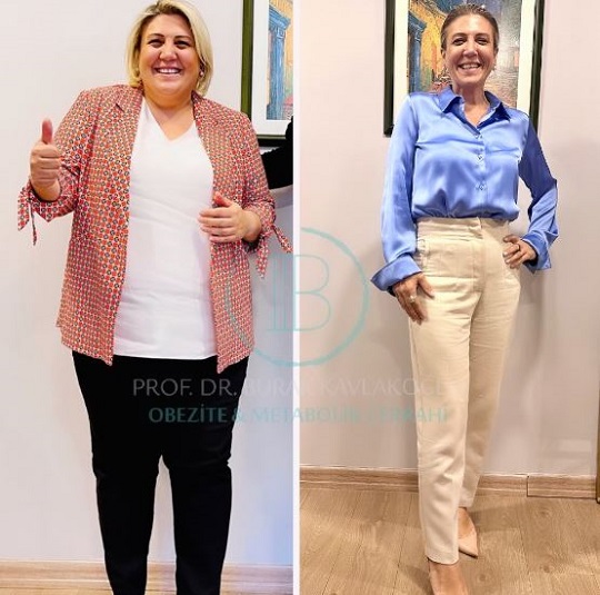 Before After Gastric Sleeve Surgery in Istanbul Turkey