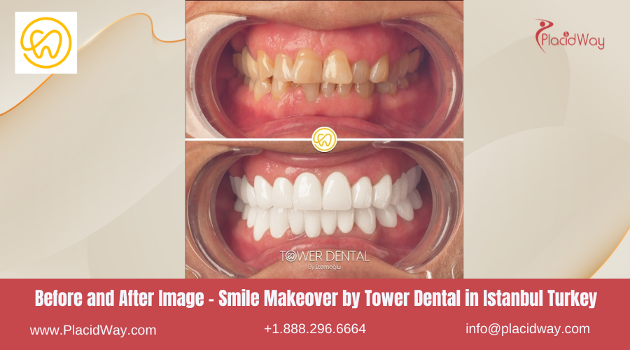 Before and After Smile Makeover by Tower Dental in Istanbul Turkey