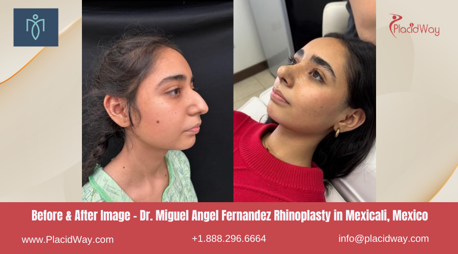 Rhinoplasty in Mexicali, Mexico by Dr. Miguel Angel Fernandez Before After Images