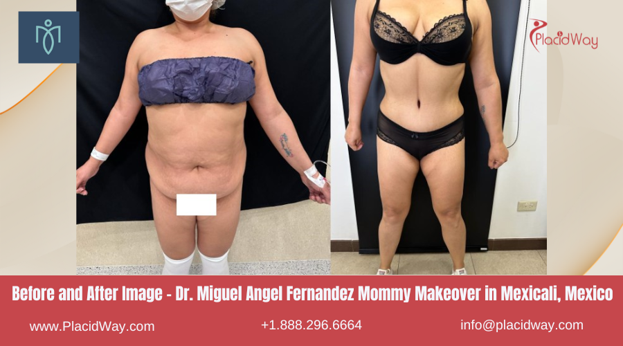 Dr. Miguel Angel Fernandez Mommy Makeover in Mexicali, Mexico Before After Images