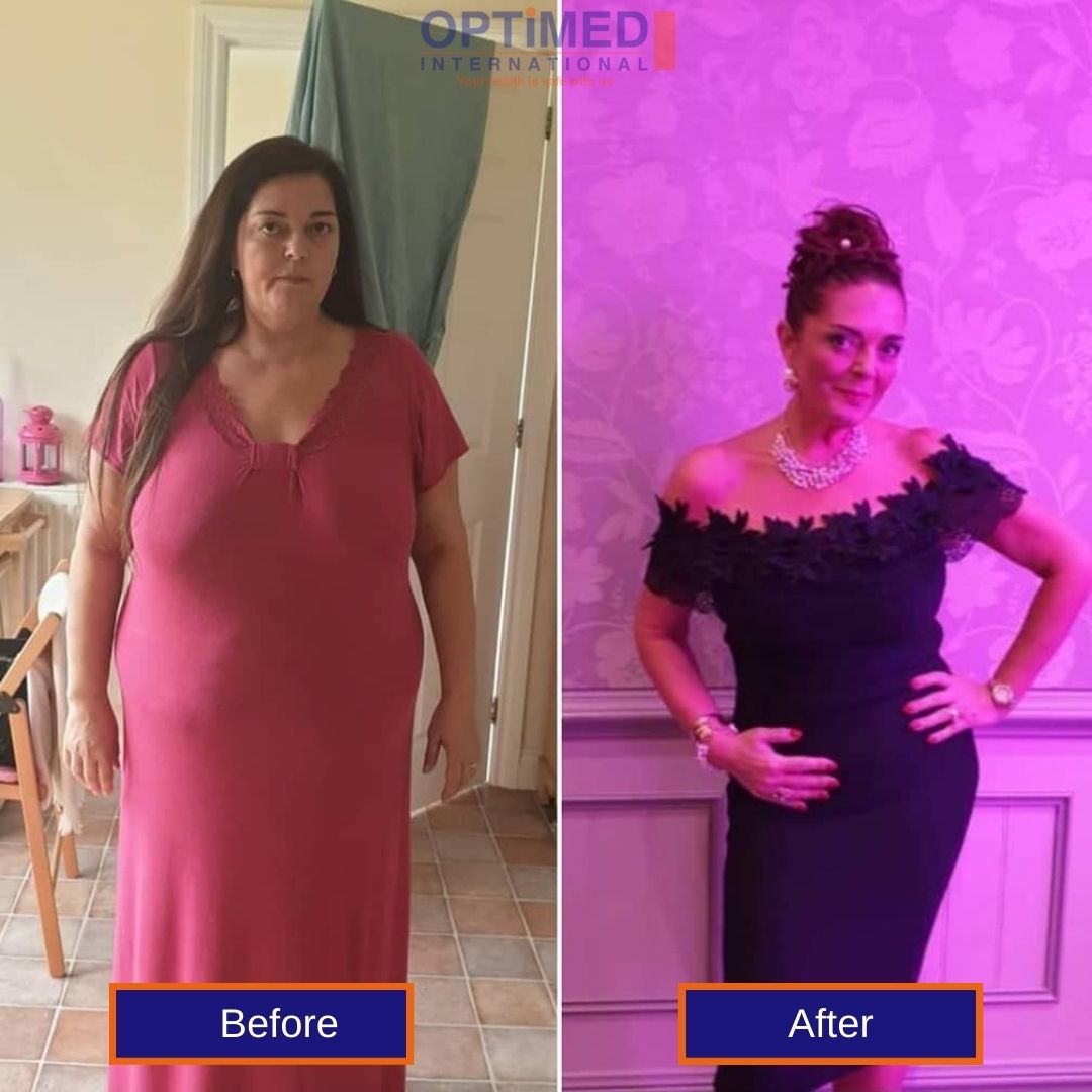 Weight loss Surgery in Turkey Before and After 3