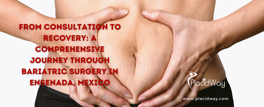 From Consultation to Recovery: A Comprehensive Journey Through Bariatric Surgery in Ensenada, Mexico
