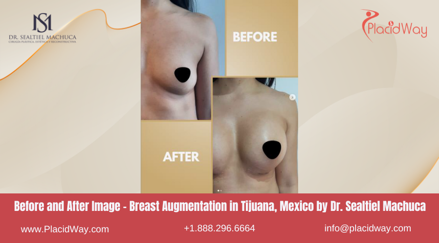 Breast Augmentation in Tijuana Mexico - Dr Sealtiel