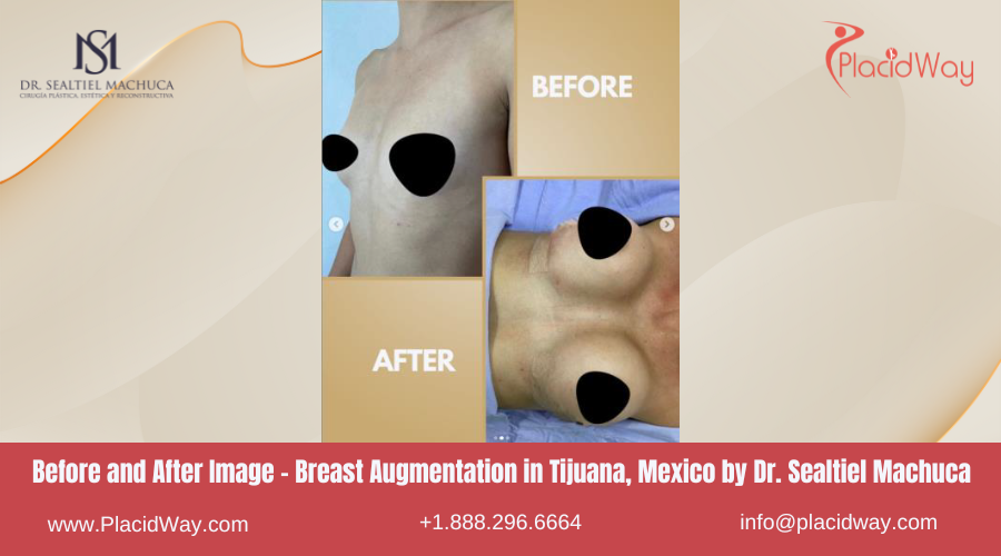 Breast Augmentation in Tijuana Mexico by Dr Sealtiel