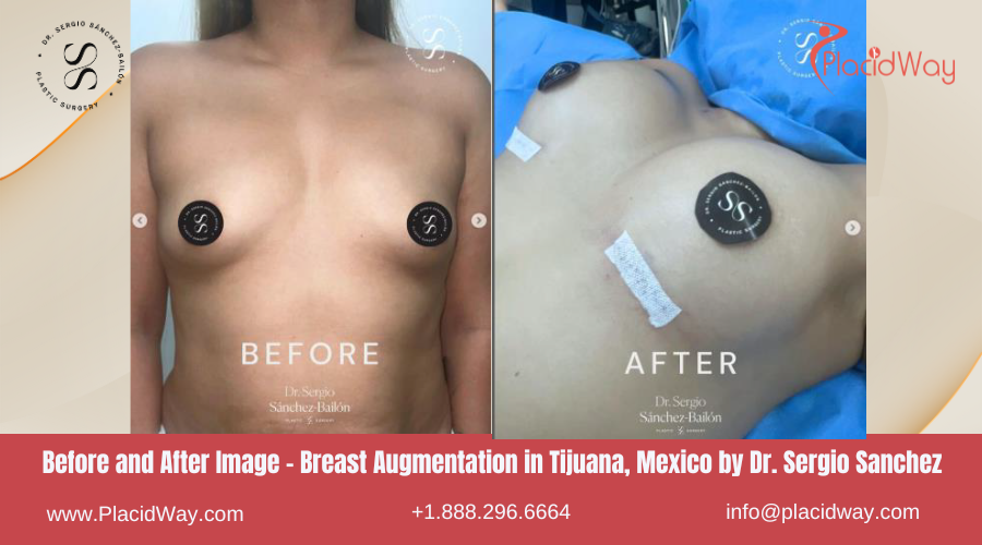 Breast Augmentation in Tijuana Mexico - Dr Sergio Sanchez