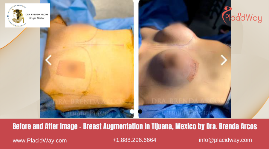 Breast Augmentation in Tijuana Mexico - Dra Brenda Arcos