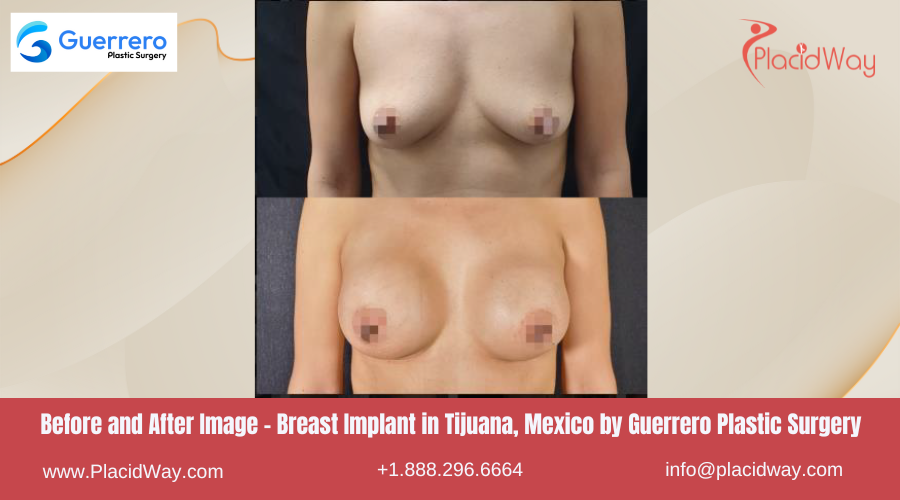 Breast Augmentation in Tijuana Mexico by Guerrero