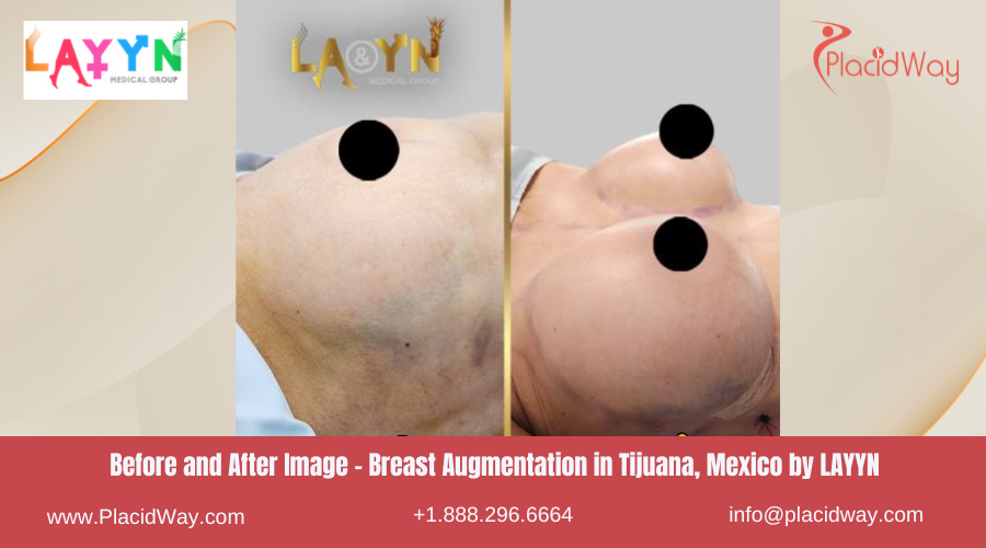 Breast Augmentation in Tijuana Mexico by LAYYN