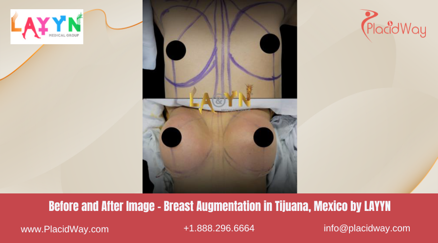 Breast Augmentation in Tijuana Mexico at LAYYN