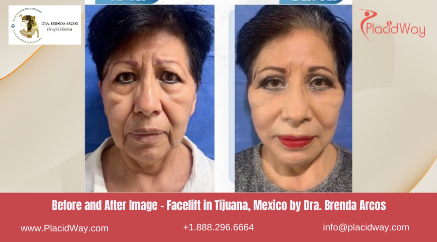 Facelift in Tijuana Mexico - Dra Brenda Arcos