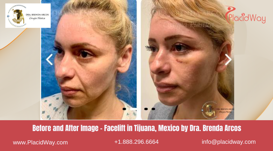 Facelift in Tijuana Mexico - Dra Brenda Arcos