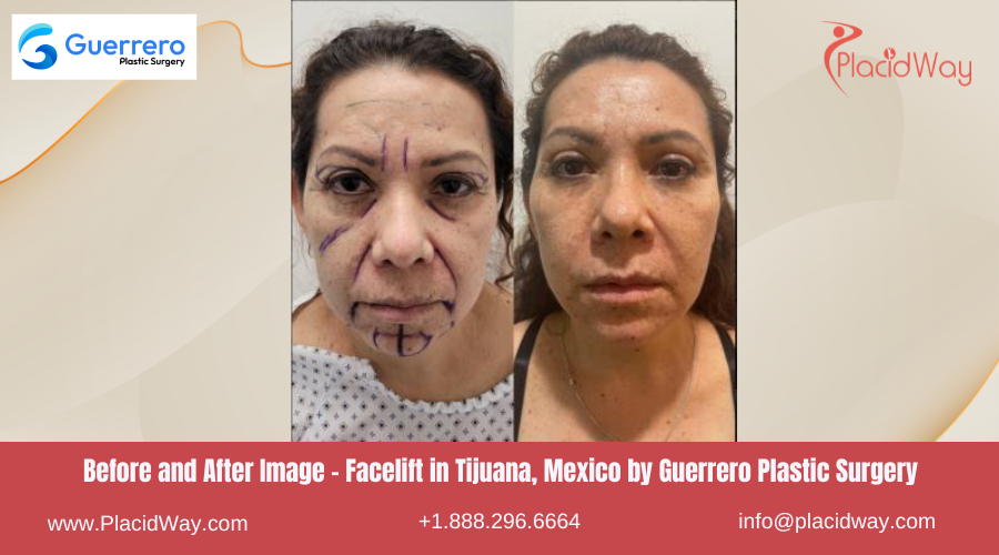 Facelift in Tijuana Mexico - Guerrero Plastic Surgery