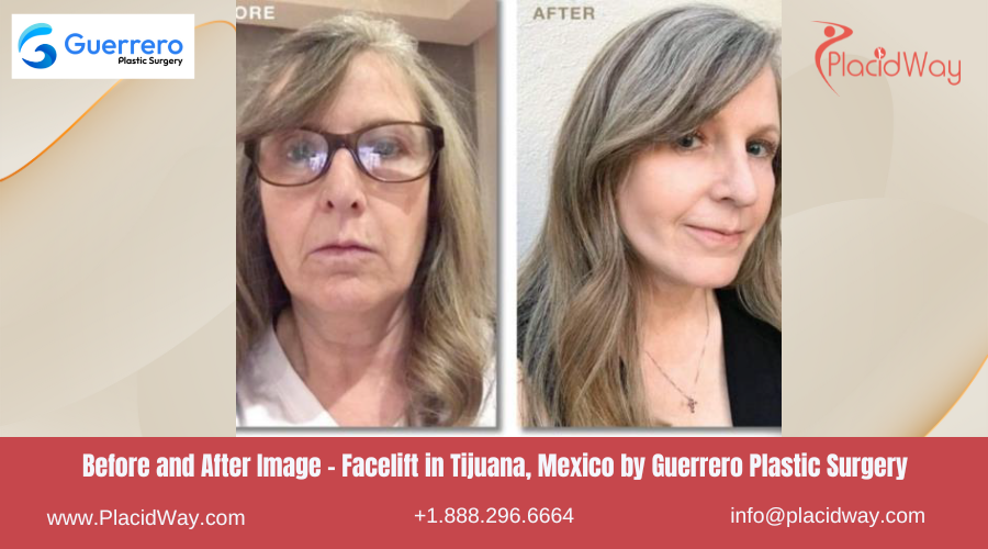 Facelift in Tijuana Mexico at Guerrero