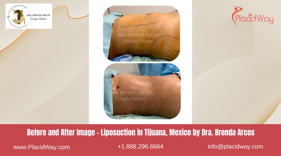 Liposuction in Tijuana Mexico - Dra Brenda Arcos
