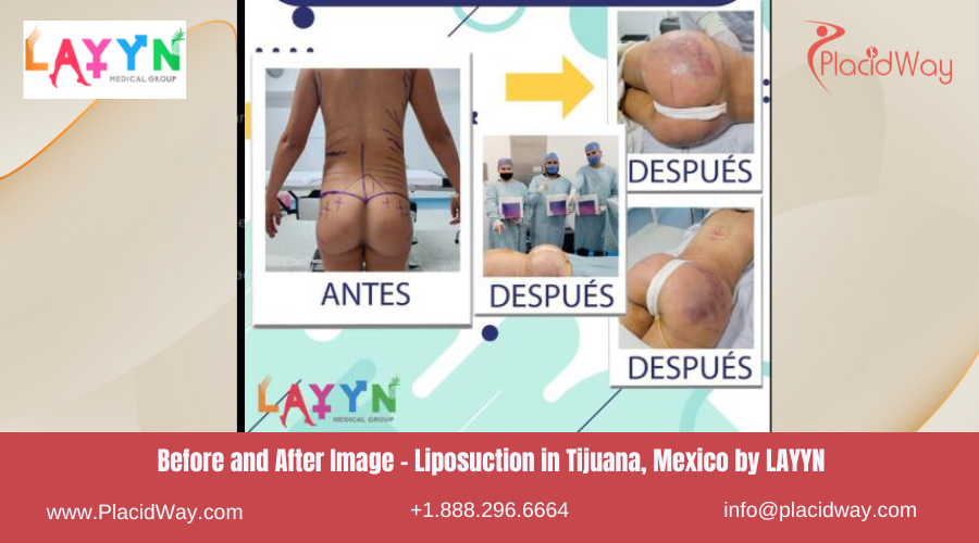 Liposuction in Tijuana Mexico - LAYYN Medical Group