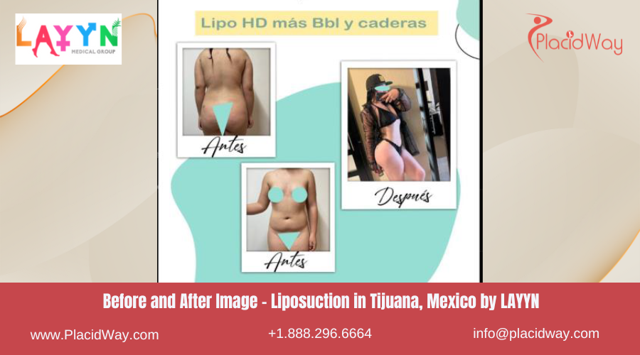 Liposuction in Tijuana Mexico - LAYYN