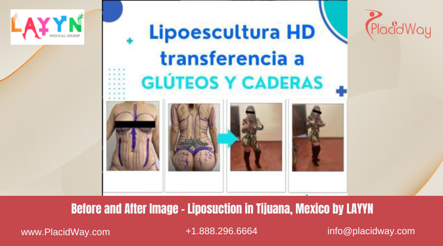 Liposuction in Tijuana Mexico at LAYYN Clinic