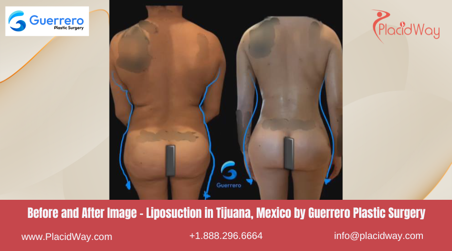Liposuction in Tijuana Mexico by Guerrero