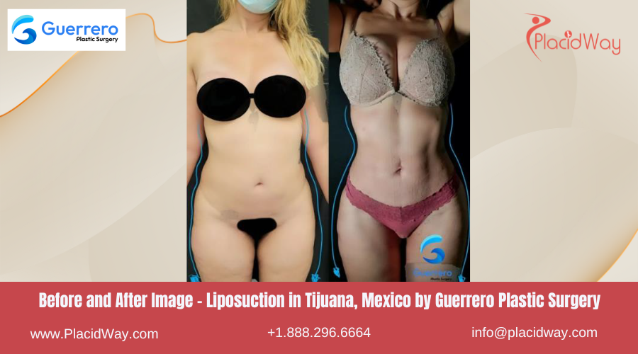 Liposuction in Tijuana Mexico by Guerrero Plastic Surgery