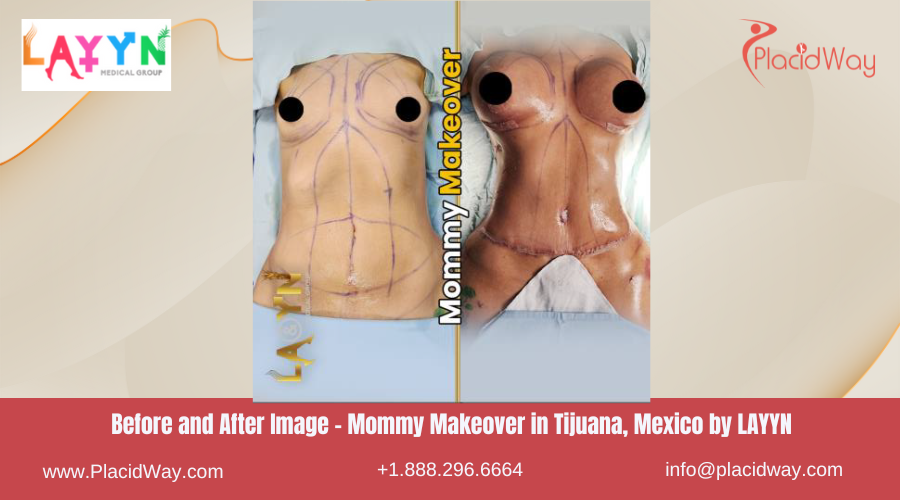 Mommy Makeover in Tijuana Mexico by LAYYN Medical Group